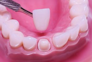 zirconia