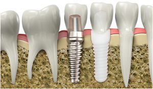 Biocompatibility of Zirconia