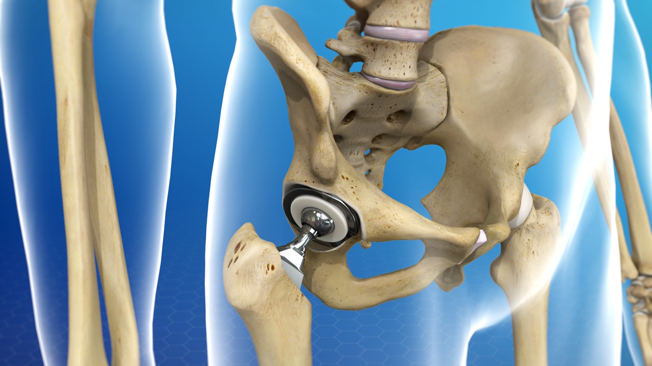 Zirconia Ceramics Application in Medical Field