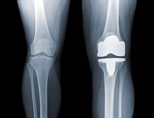 Use of ceramics and metals in artificial joints