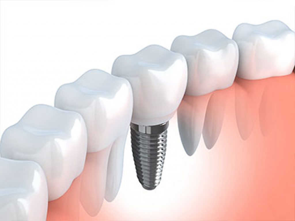 zirconia dental implants